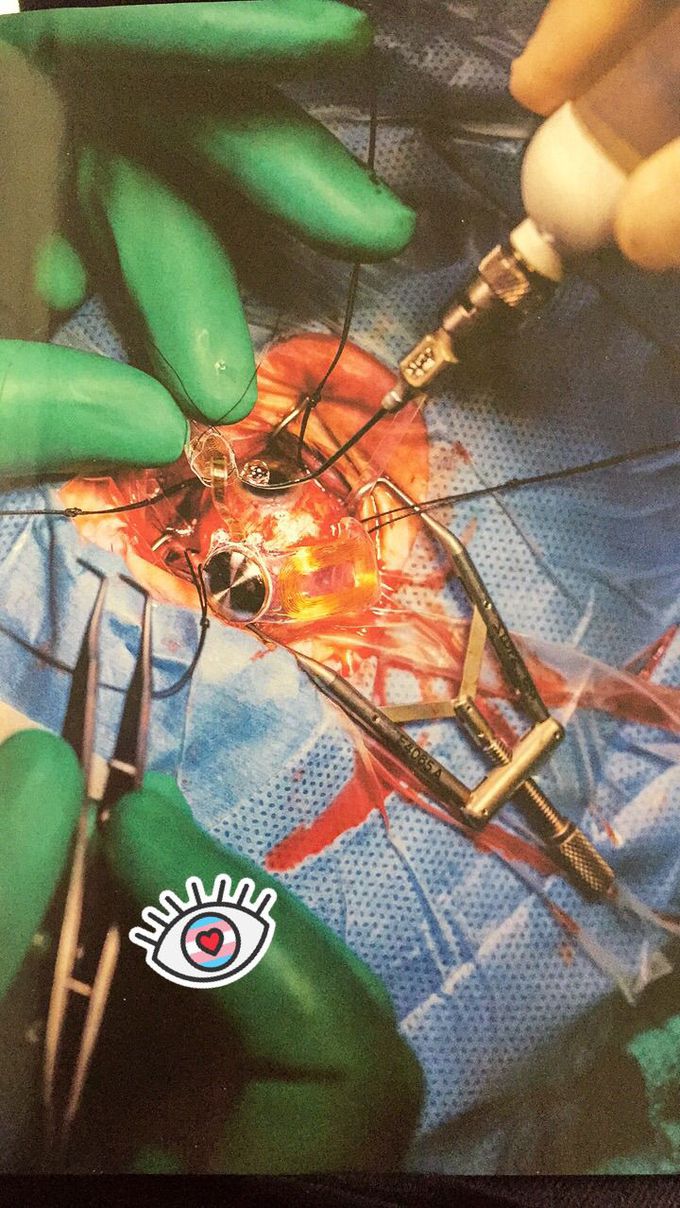 Argus II implant