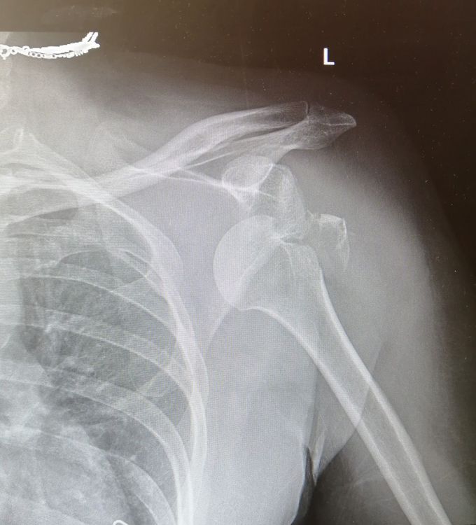 shoulder dislocation with fracture of the greater tuberosity