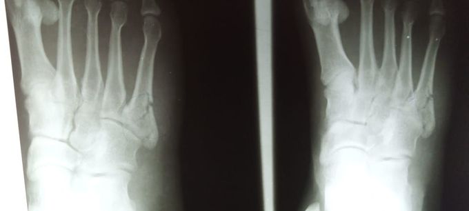 Base of fifth metatarsal Fx (Undisplaced)