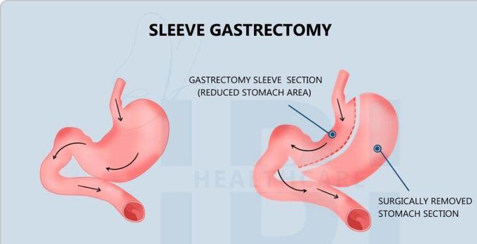Sleeve gastrectomy