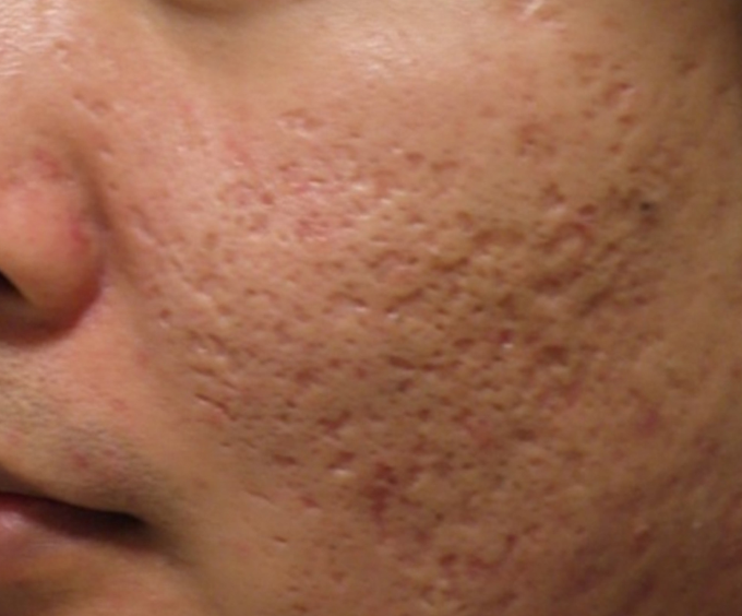 Acne scar