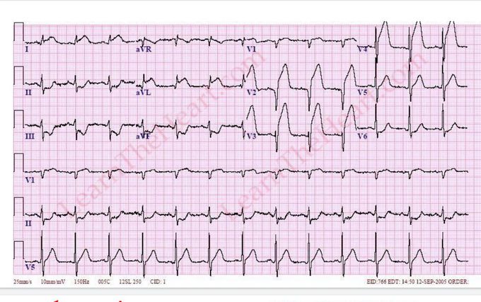 Describe this ECG