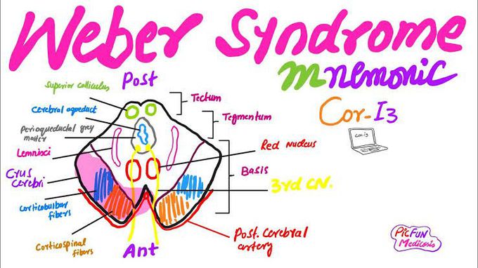 Symptoms of webers syndrome