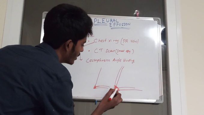 Pleural effusion in a simple way