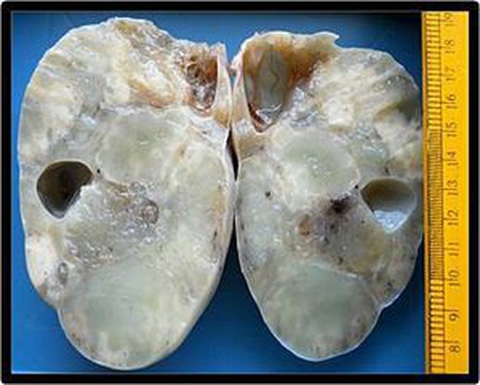 KRUKENBERG TUMOUR