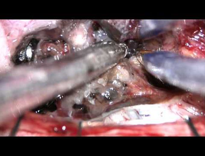 Microsurgical resection of intramedullary spinal cord cavernous malformation. Operative video