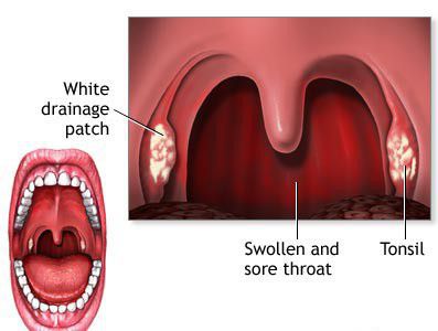 Strep throat - MEDizzy