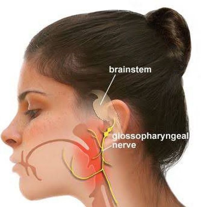 Glossopharyngeal Neuralgia