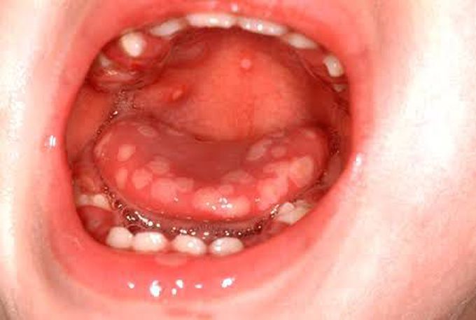 Gingivostomatitis