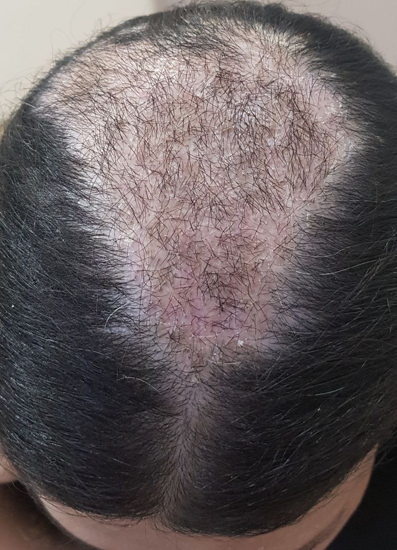 Skin burns hair transplant - MEDizzy