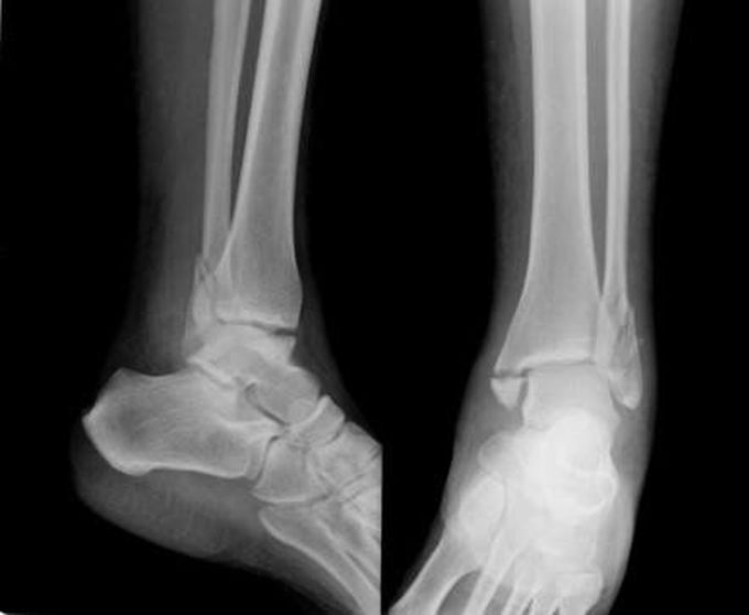 Trimalleolar fracture