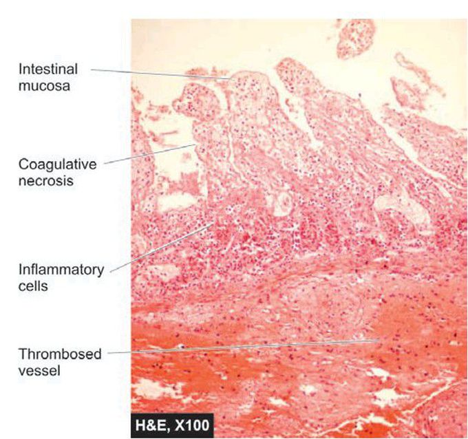 Infarct small intestine, microscopic appearance.