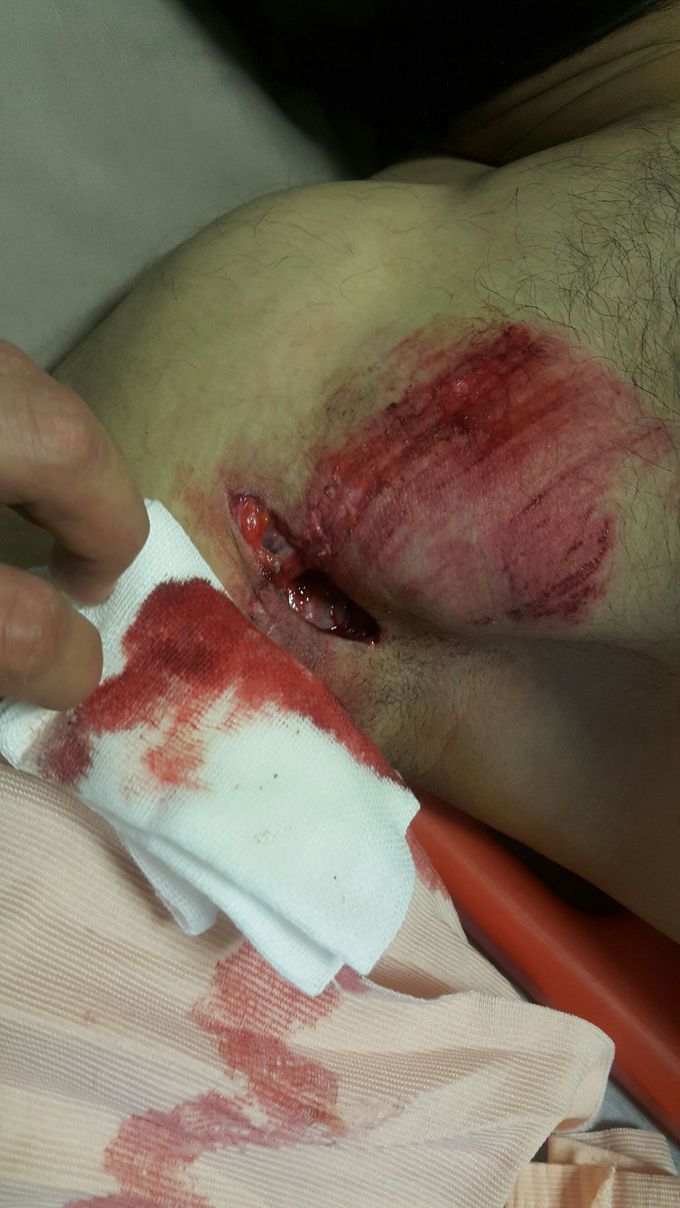 Axillary laceration
