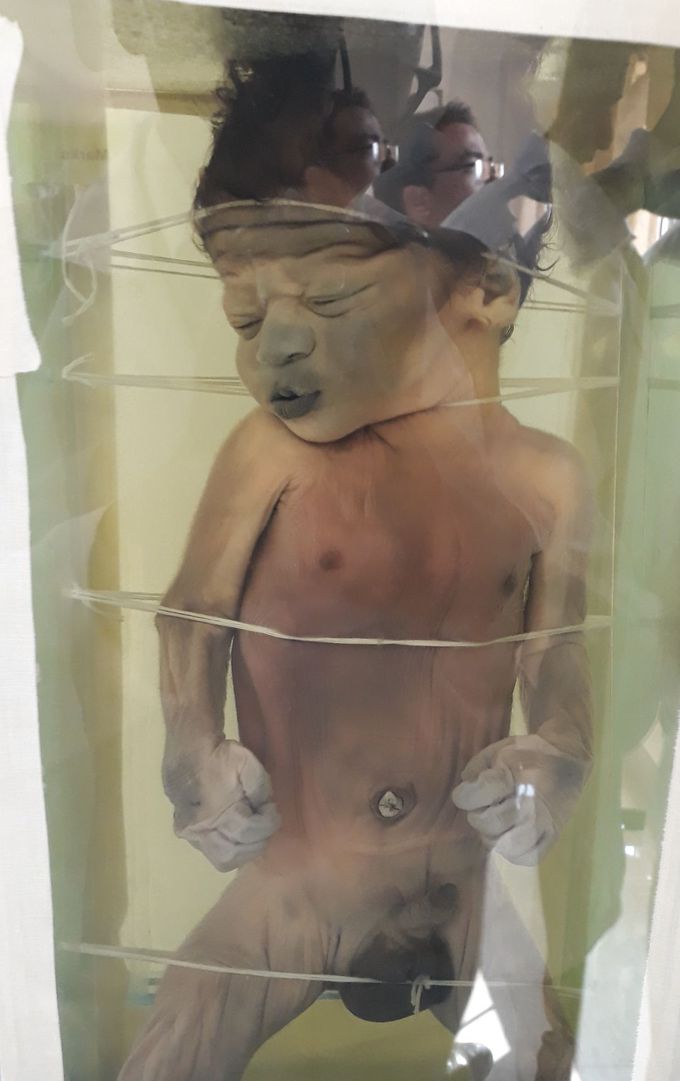 Guess the age of the fetus