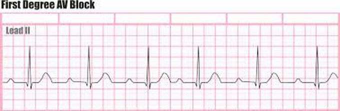 First-degree AV block (PR prolongation)