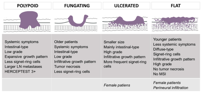 Borrmann's Classification of Gastric Cancer