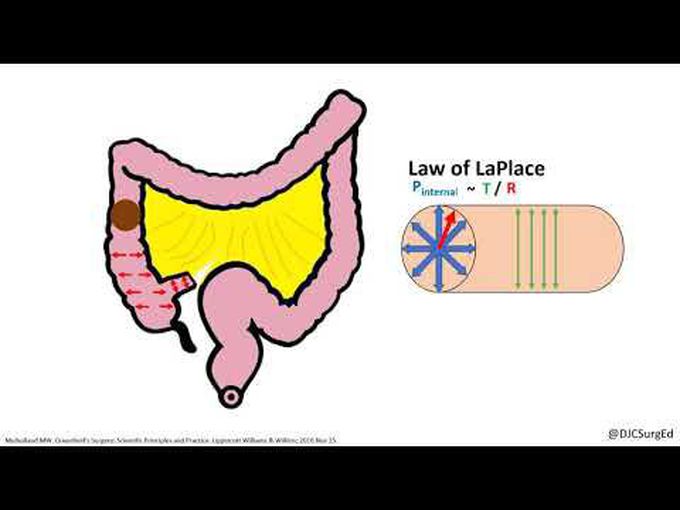Colonic Volvulus-Explanation