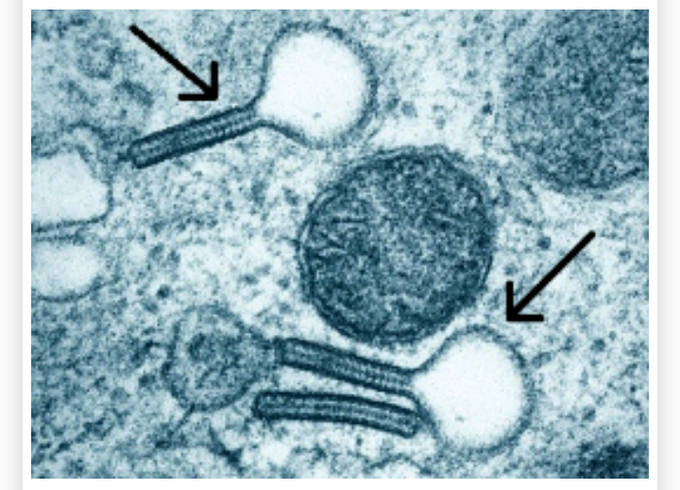 The characteristic appearance of cytoplasmic bodies in the electron microscopic image is seen in which disease?