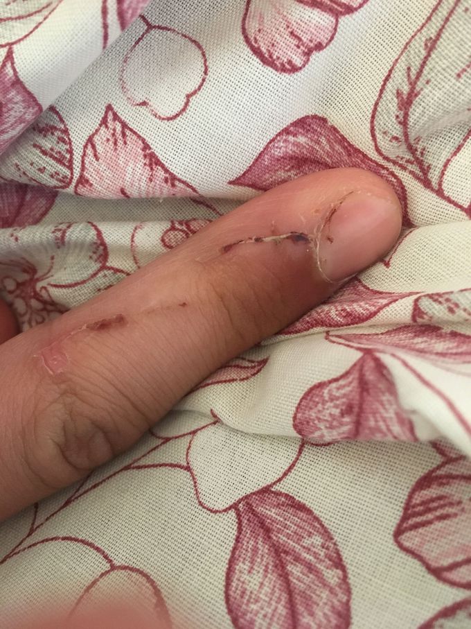Healing ceiling fan wound.