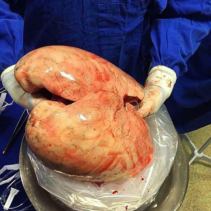 A new pair of lungs about to be transplanted!