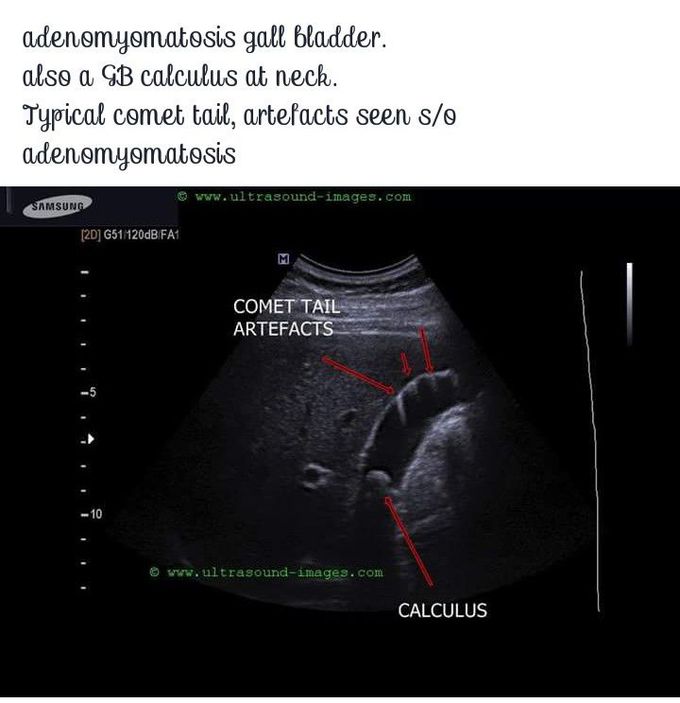 #calculus# gallbladder # adenomyomatosis#