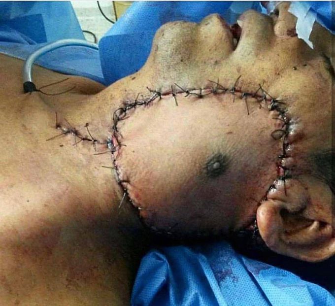 A nipple on a very unusual location.  