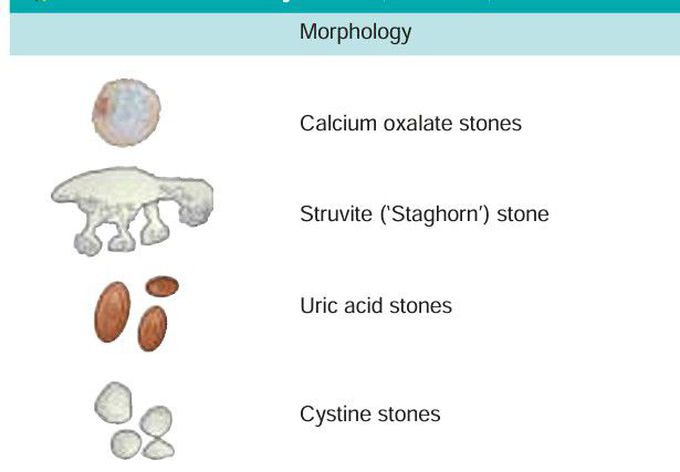 Renal stones