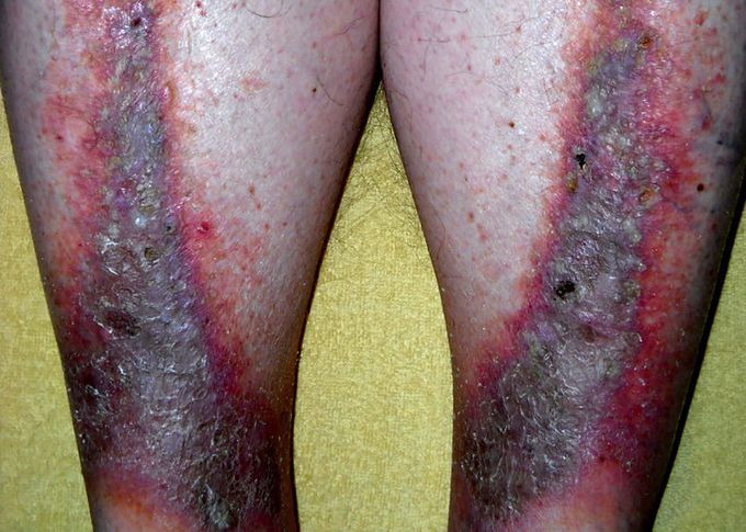 Causes of Stasis dermatitis