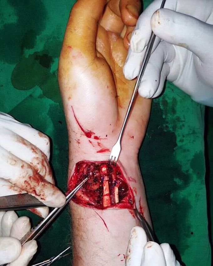 Hand injury