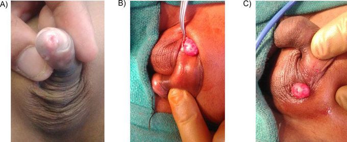 Complications of Cryptorchidism