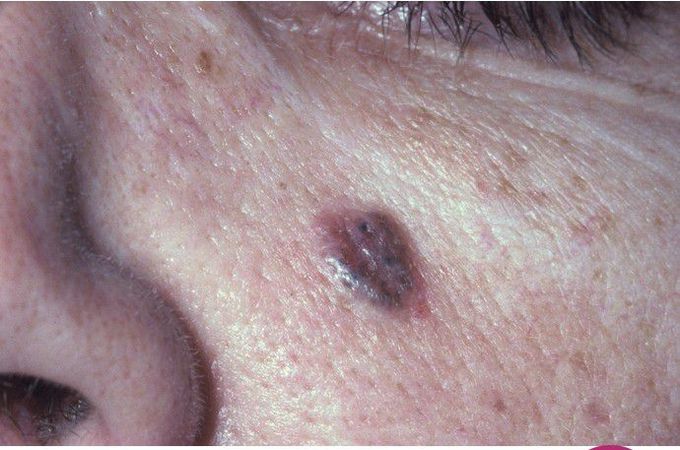 Basal Cell Carcinoma