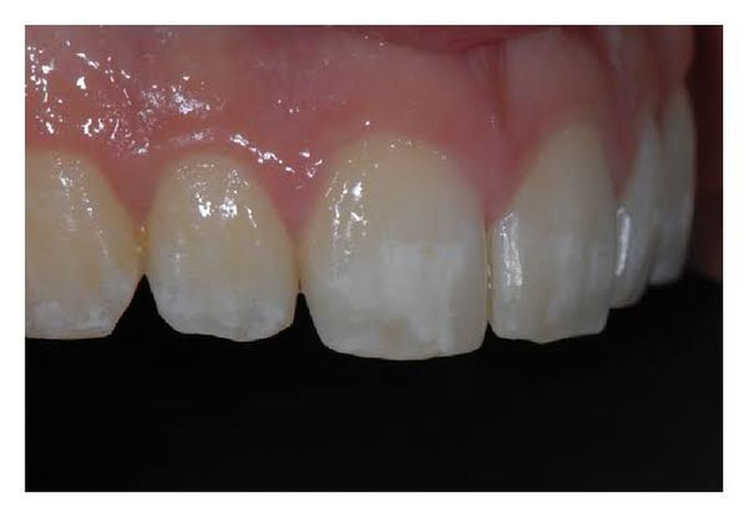 Hypomineralization of tooth