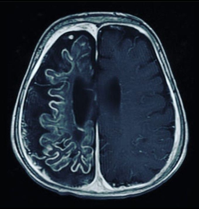 Sturge weber syndrome