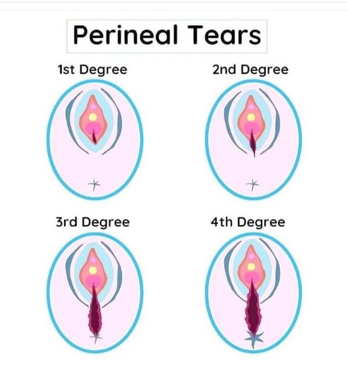4 Degrees of Perineal Tears 