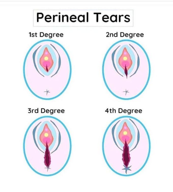 4 Degrees of Perineal Tears 