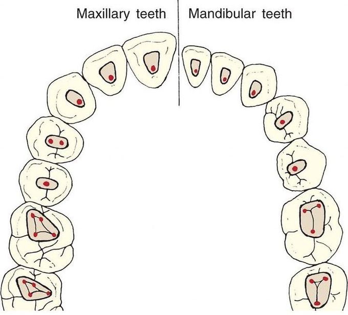 Endodontic Access Points