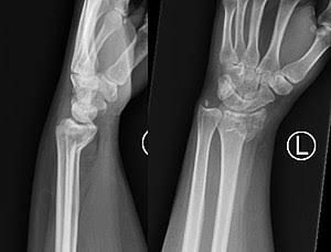 Smiths fracture