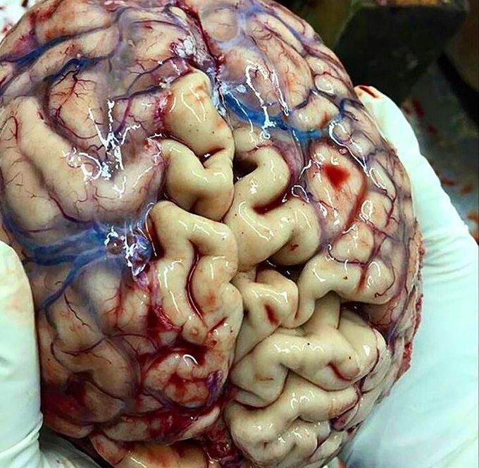 This brain is partially covered with the arachnoid and pial layers of the meninges.