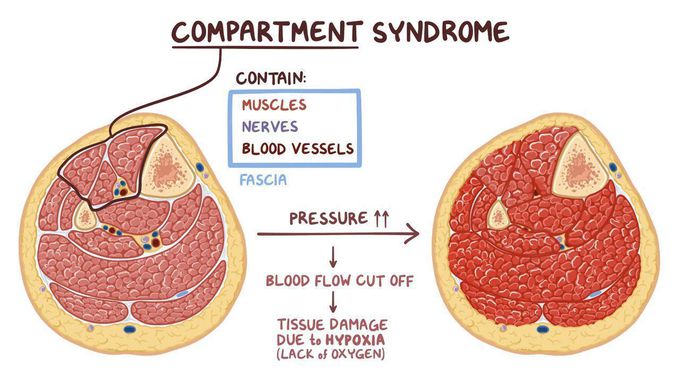 Compartment Syndrome