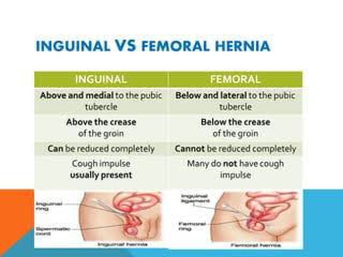 Inguinal Vs femoral Hernia