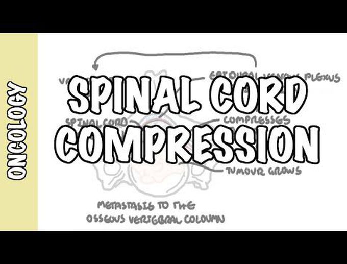 Spinal Cord Compression -  medical emergency, causes, symptoms, diagnosis, treatment