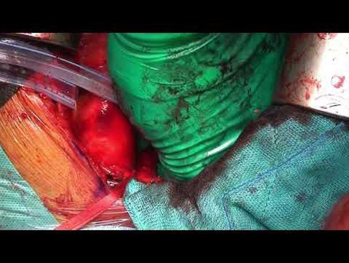 Transsternal Transpericardial Approach for Left Main Bronchus Sleeve Resection