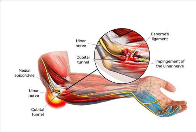 Treatment for  Cubital tunnel syndrome