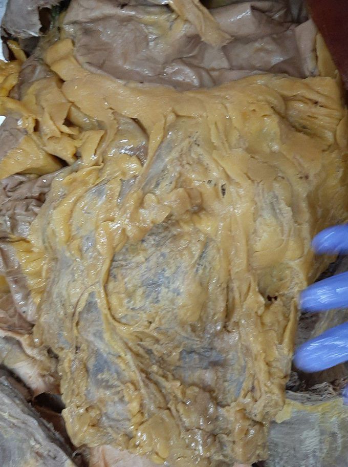 Greater Omentum