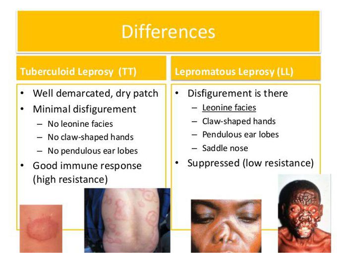 Tuberculoid vs Lepromatous Leprosy