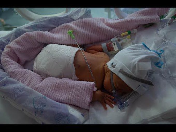 A premature baby