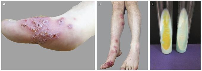 Sporotrichoid Mycobacterial Infection