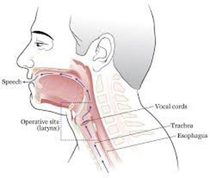 Laryngectomy