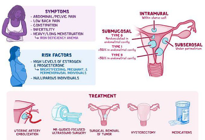 Symptoms of uterine fibroids