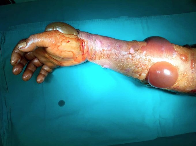 Arm after a snake bite showing signs of tissue necrosis!